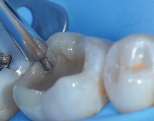 Instrumentets gaffelformade spets möjliggör modellering av den proximala väggen för att kopiera den angränsande tandens