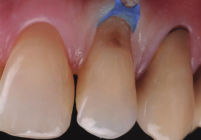 LM-Gengiva tandköttsretraktionsset LM 7556K ES LM 7556K XSI Innehåller LM-Gengiva-handinstrument, blå tandköttsretraktorer (förpackning med ca 90 st., 30 st.