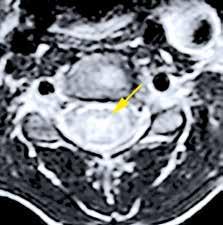 Inget patologiskt kontrastmedels upptag påvisades (Figur 1). MR ingav först misstanke om spinal tumör, men eftergranskning visade en mer tydlig inflammatorisk bild och tumörmisstanken kunde avskrivas.