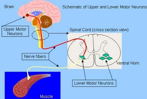 Bild 4 Övre motorneuron Hjärnans motoriska neuron samt deras axon Kliniskt: Svaghet + Spasticitet + Stegrade reflexer 4 Bild 5 Nedre