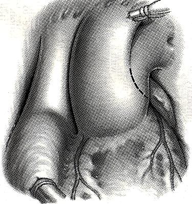 Conduitkirurgi Truncus arteriosus Gemensamt utflöde till en truncus PA från aorta