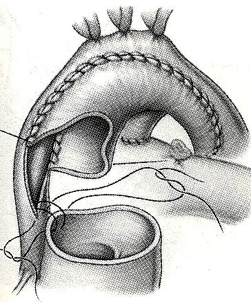 Conduitkirurgi Norwoodoperationen: Från Stark, deleval Surgery for Congenital