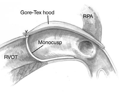 in Thoracic and