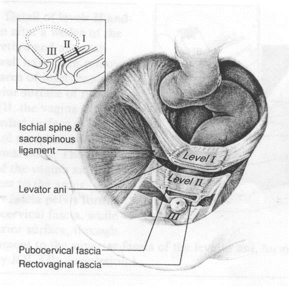 Level I suspension De Lancey`s levels of