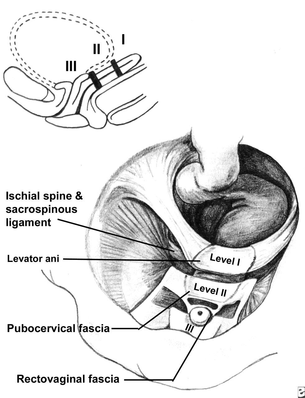 Level II - attachement Den mellersta delen av vagina får stöd från pubocervikala fascian och