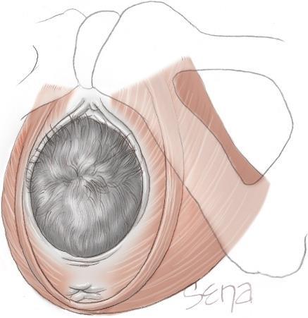 Den vaginala förlossningen är ett trauma mot bäckenbotten Kompression när fosterhuvudet