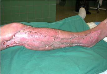 infektsiooni episood kõrge kehatemperatuuriga, sepsise kliinilise pildiga Algul tekib nahale punetus ja turse, protsess levib