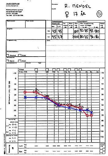 Exempel 11 Hereditär sensorineural hörselnedsättning kan ha vilken form som helst på hörselkurvan. Diskantnedsättning eller mellanregisternedsättning är vanligast.