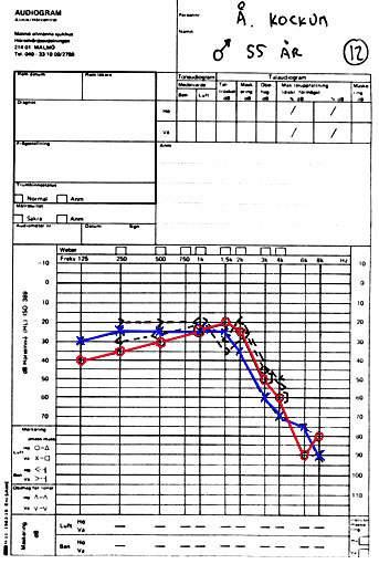 Exempel 12 Bullerskada brukar som nämnt drabba först i området 3-6 khz. Brant lutande kurva är typisk.