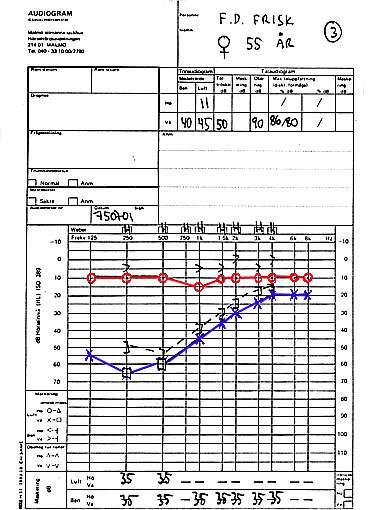 Exempel 3 Patienten har anfall av yrsel av rotatorisk art. Försök ånyo att tolka audiogrammet och att göra en klassifikation av skadan som sensorineural eller ledningshinder. Facit: Höger öra normalt.