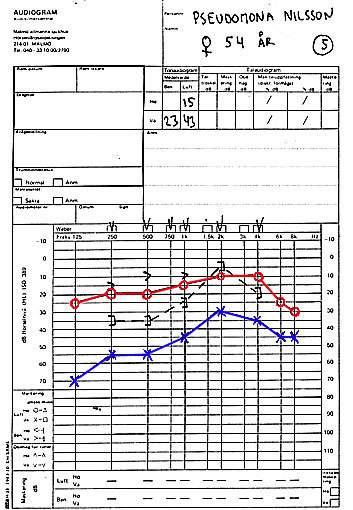 Exempel 5 Höger öra normalt. Vänstersidig hörselnedsättning där även benledningen är något sänkt. Anledningen till detta vet vi ej men patienterna har ofta en tendens att inte riktigt följa läroboken.