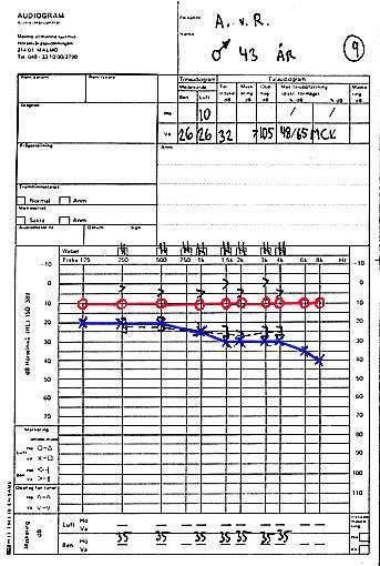 Exempel 9 Ensidig sensorineural hörselnedsättning vänster sida. Taluppfattningen är endast 48%. Detta är alarmerande! Man ska då misstänka retrocochleär skada.