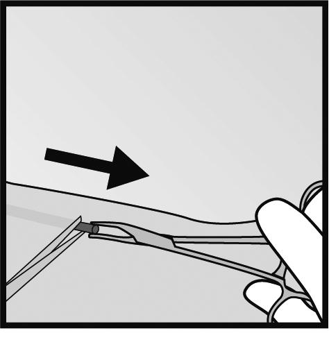 implantatet med en peang (Bild 13 och 14).