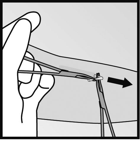 Det har förekommit rapporter om trasiga implantat i patientens arm.