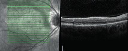 Preretinal och intraretinal makulablödning. Figur 8. Intraretinal vaskulär anomali. Figur 9.