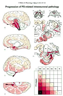 Braaks hypotes Sjukdomsprocess (intracellulära lewybodies) börjar i hjärnstam (först vaguskärnor) och luktlober.