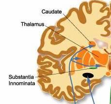 Subthalamus - Parkinson