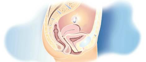 Funktionella symtom Mekaniska symtom Globuskänsla Tryck/tyngdkänsla Smärta i perineum Urinsymtom Ansträngningsinkontinens Trängningsinkontinens Frequency Trängningar Dålig stråle