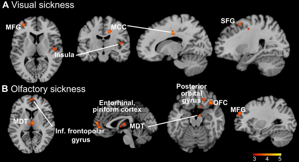 Hjärnan registrerar subtila sjukdomsledtrådar Figure 3. Whole-brain activation to visual sickness (3A) and olfactory sickness (3B), t-contrasts from a random-effects general linear model (GLM).