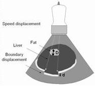 Uppgift 16 (2p) Ljudhastigheten i fett är något lägre än för annan mjuk vävnad. Detta innebär att vi kan få en förskjutning i ultraljudsbilden för de områden som skuggas av fettrik vävnad.