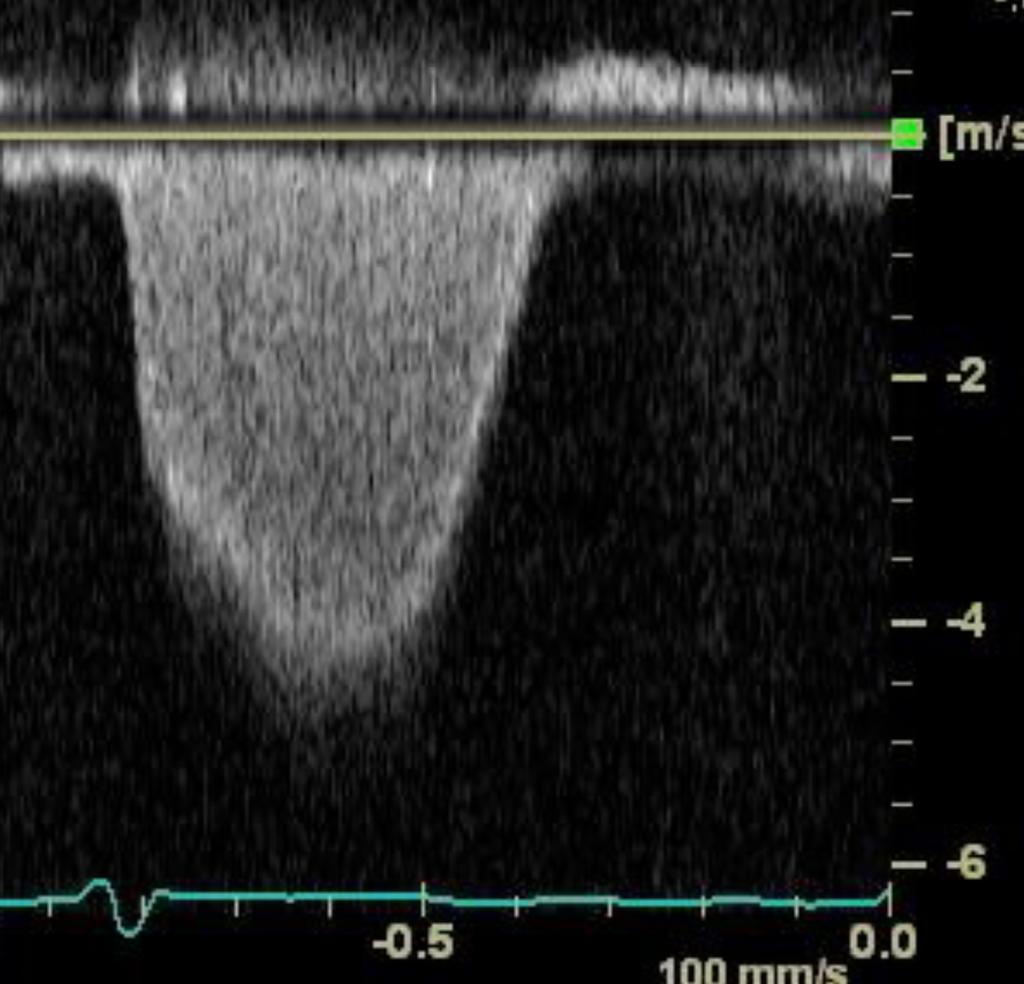 Di Tryck och resistans i lungcirkulationen Surrogat PVR-Abbas metod* RVOT TRV=4.