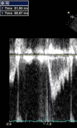 ms) Kort Act (<85 ms*) Midsystolic