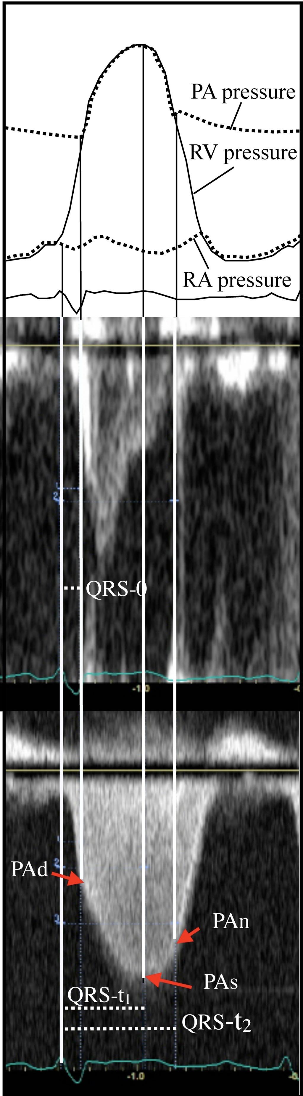 Tryck och resistans i lungcirkulationen Surrogat PVR>3 WU:Tryckreflektion AcT: Acceleration time (ms) tpv-pp: Interval between peak velocity in the RVOT and peak RV