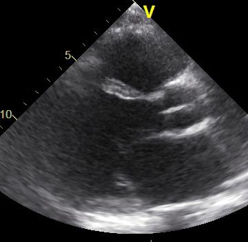 Pulmonary hypertension in heart failure Case #1 Male, 49