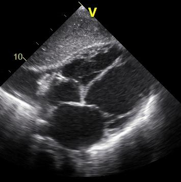 Pulmonary hypertension in