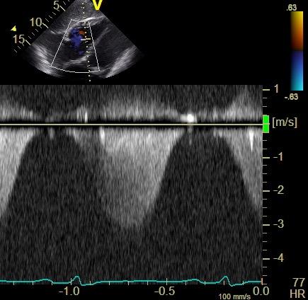 pressure Pulmonary