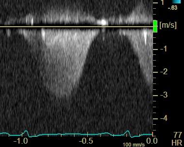 1 mmhg PVR<3 WU AP 0 mmhg.