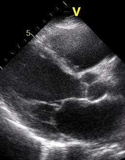 Pulmonary hypertension in heart failure Case #2 Male, 56 years