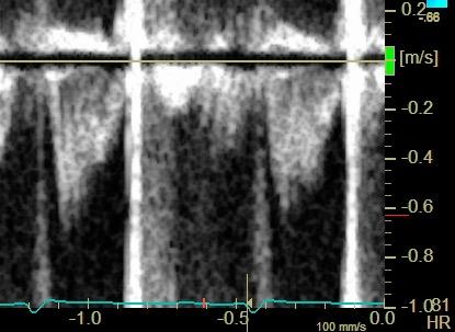 Pulmonary hypertension in heart failure Case #2 AcT 60 ms tpv-pp 111 ms Rule in PVR>3 WU Act <80 ms tpv-pp > 80 ms