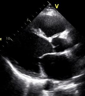 Pulmonary hypertension in