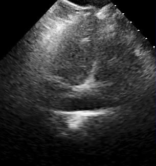 Pulmonary hypertension