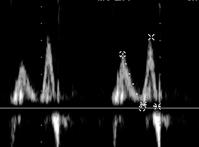 heart failure Case