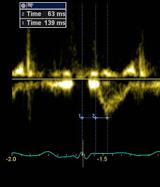 AP 8 mmhg PASP 62