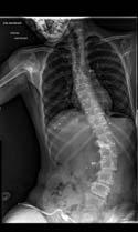 Without brace With brace Analysis of sitting with pressure