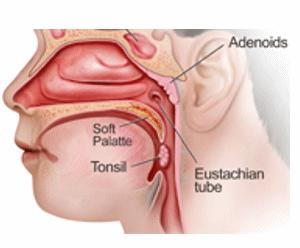 Adenoid