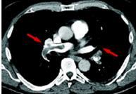 Sammanfattning VTE Misstänk DVT/LE Använd diagnostikstöd Använd