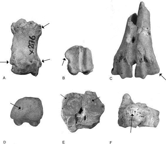 Figur 5: (A) Proximal and distal exostosis (stage 3) on the first phalanx, (B): lipping (stage 4) on Phalanx 1, (C) asymmetry (stage 3) in metatarsal bone, (D) distal depression (type 4 in site C) in