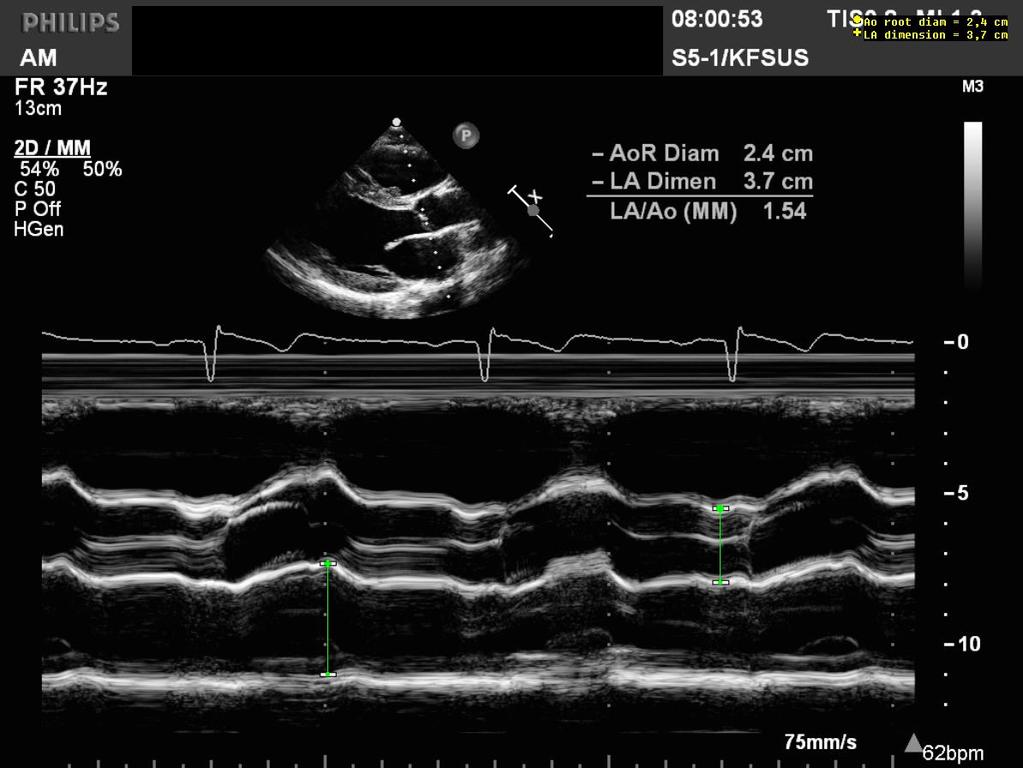 Figur 1. Mätning av vänsterförmakets anteroposteriora diameter i slutsystole med hjälp av M- mode.