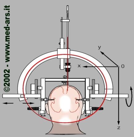 Implantation av internal pulse generator