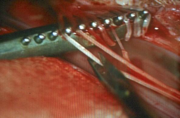 Procedures - neurosurgery Unilateral laminoplasty L2-L5 laminae flap fastened in the end of op Posterior roots in cauda equina identified, anatomical level confirmed EMG-recording of