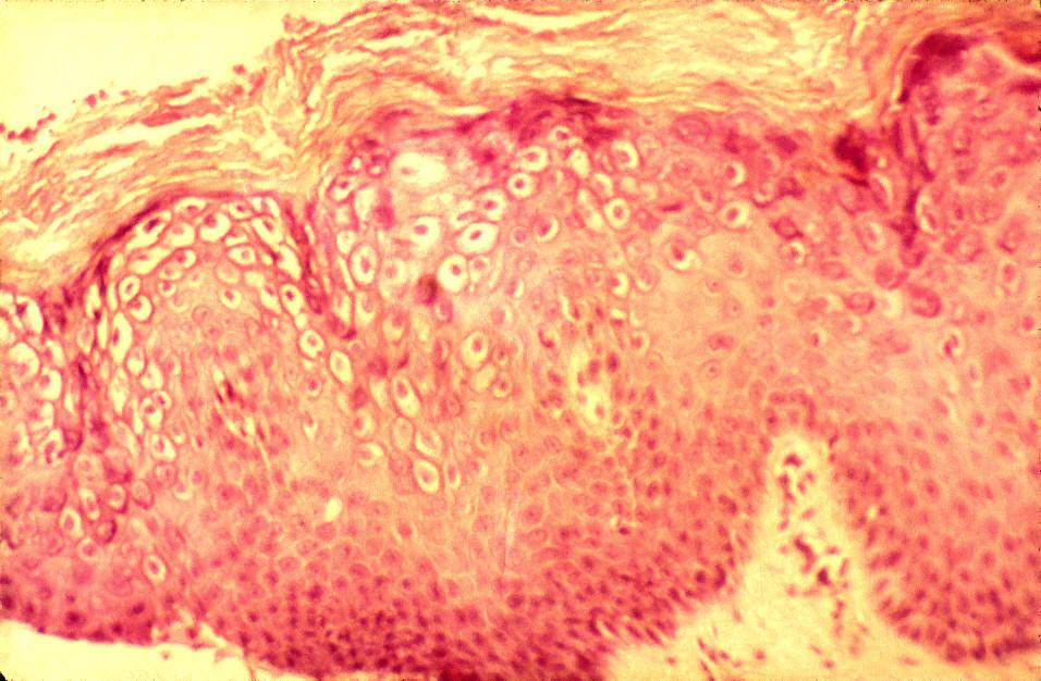 Diagnos(k kondylom - Klinisk bild - Histologi (biopsi endast om ej typiska