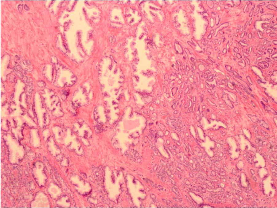 B2) Bilden nedan visar en malign tumör. a) Vilken är diagnosen?