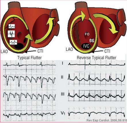 Macroreentry Förmakshastighet 250-350 sl/min >90% typiska fladder isthmusberoende Atypiska fladder Vänster höger Ofta kopplat till