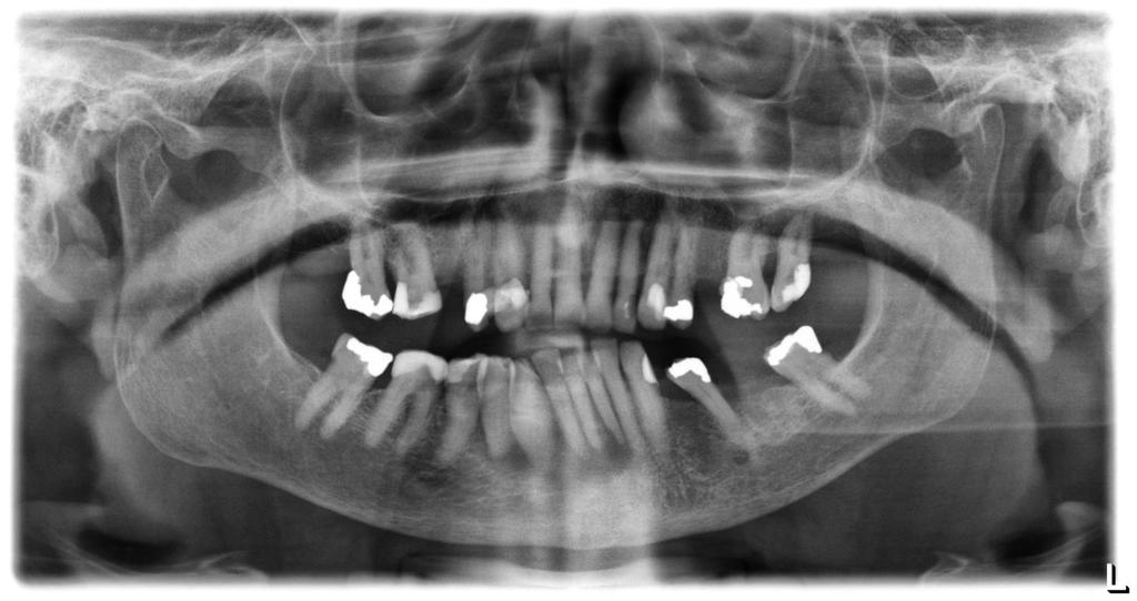 Patientfall -palliativ Dement dam med gingivalcancer.