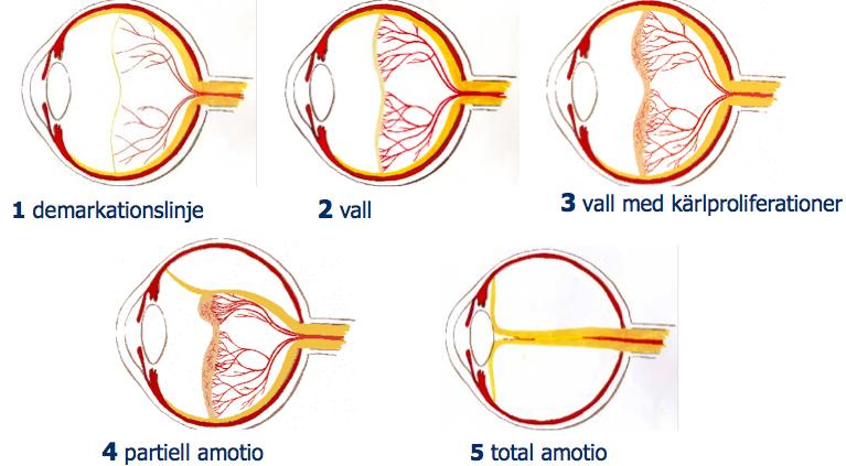o Småvinklig skelning o Stor risk för amblyopi o Upptäcks ofta vid 4- årskontrollen o Behandling: amblyopibehandling Ackommodativ esotropi ögonen behöver hyperopkorrektionen för att slappna av.