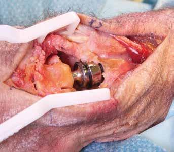 Se systembroschyren för Motec Wrist Prosthesis och